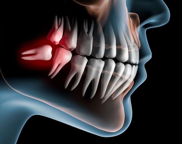 20'lik diş ağrısı nasıl geçer